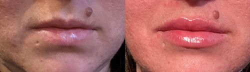 Dermal Filler Ashland KY - Before & After Lower Face and Lip Treatment